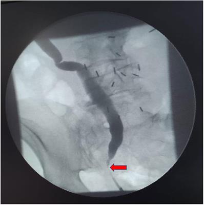 Allium stent as a curative treatment for benign ureteral strictures: Preliminary experience, surgical technique, and functional results